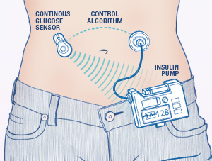 Graphic of Insulin Pump and CGM